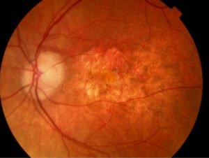 dry AMD RPE atrophy