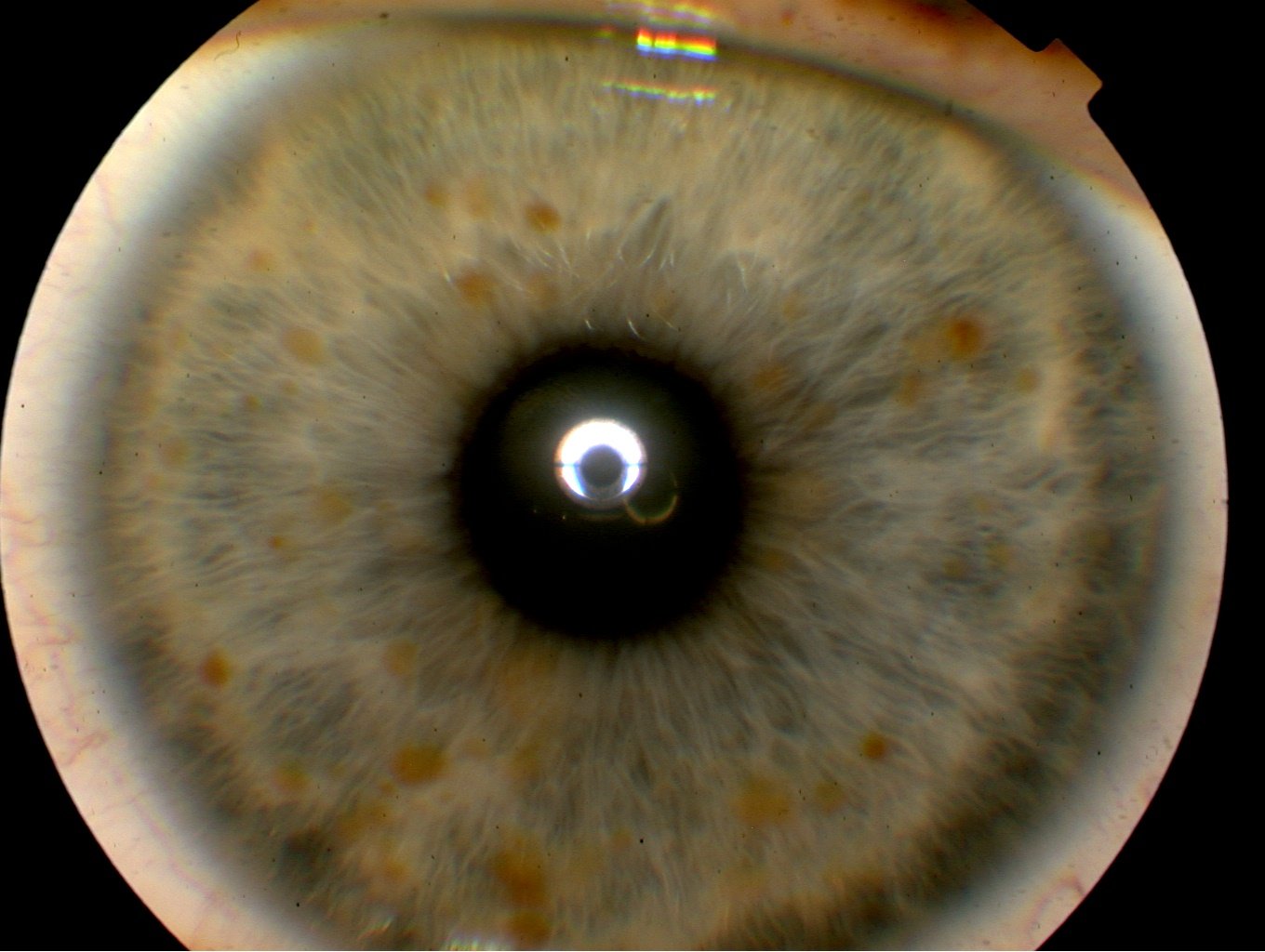 Iritis (uveitis) Lewes, Sussex - Eye Clinic